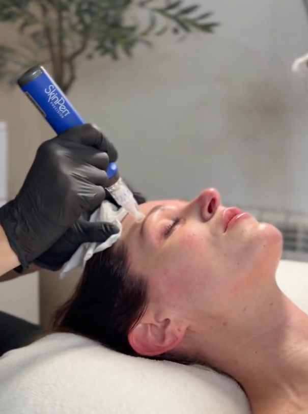 SkinPen® The Treatment Everyone Is Talking About (And Why We Love It)
