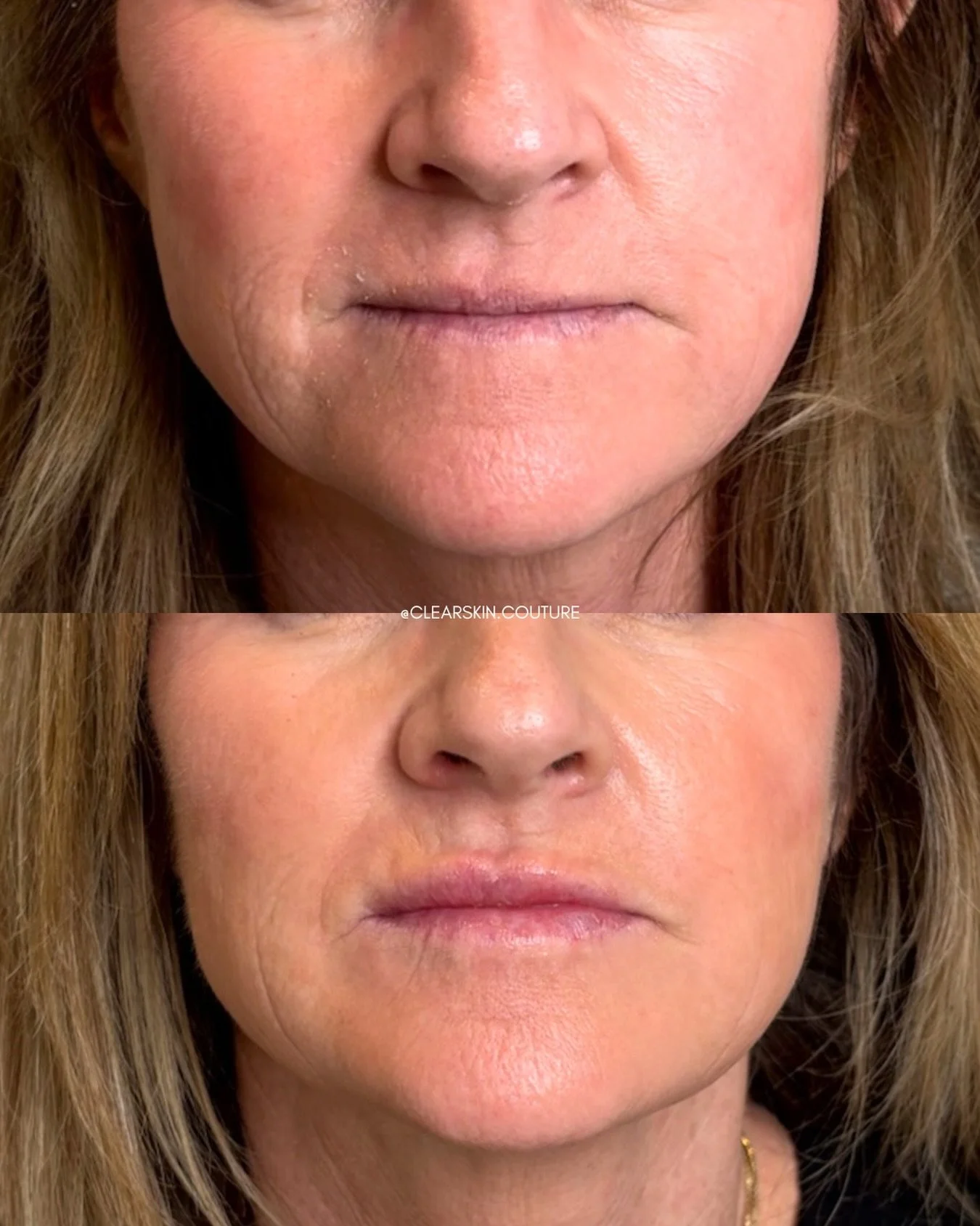 At Clearskin Couture, we don&rsquo;t chase trends, we create long-term aesthetic plans designed to deliver consistent, natural-looking results over time.

Every treatment is thoughtfully chosen to support your facial balance, skin health, and persona