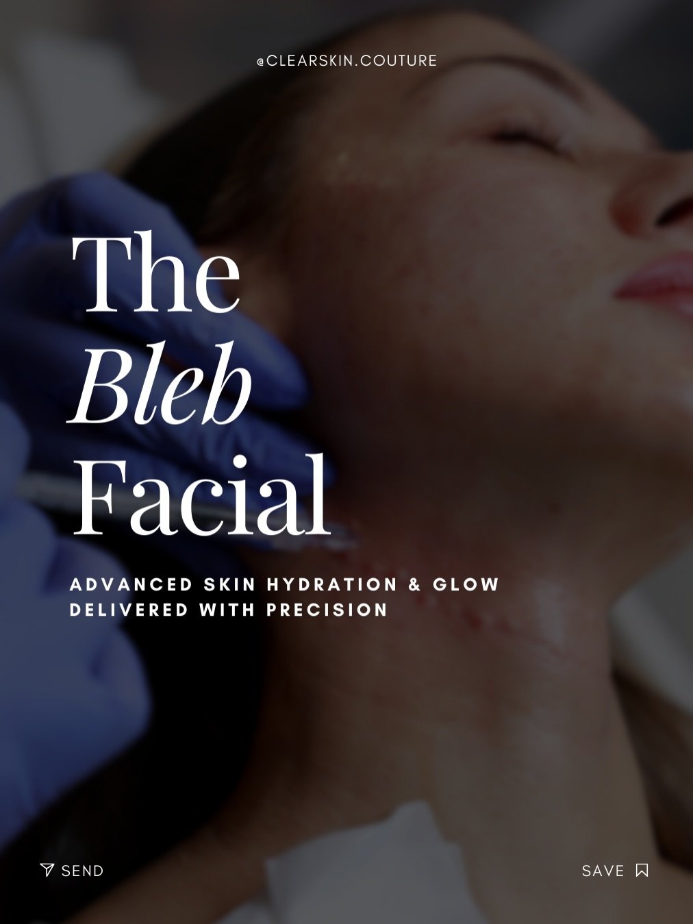 The Bleb Facial at Clearskin Couture uses MicronJet technology to deliver skin-boosting ingredients beneath the surface for deep hydration, improved texture, and a natural glow. 

Ideal for patients seeking advanced facial treatments with minimal dow