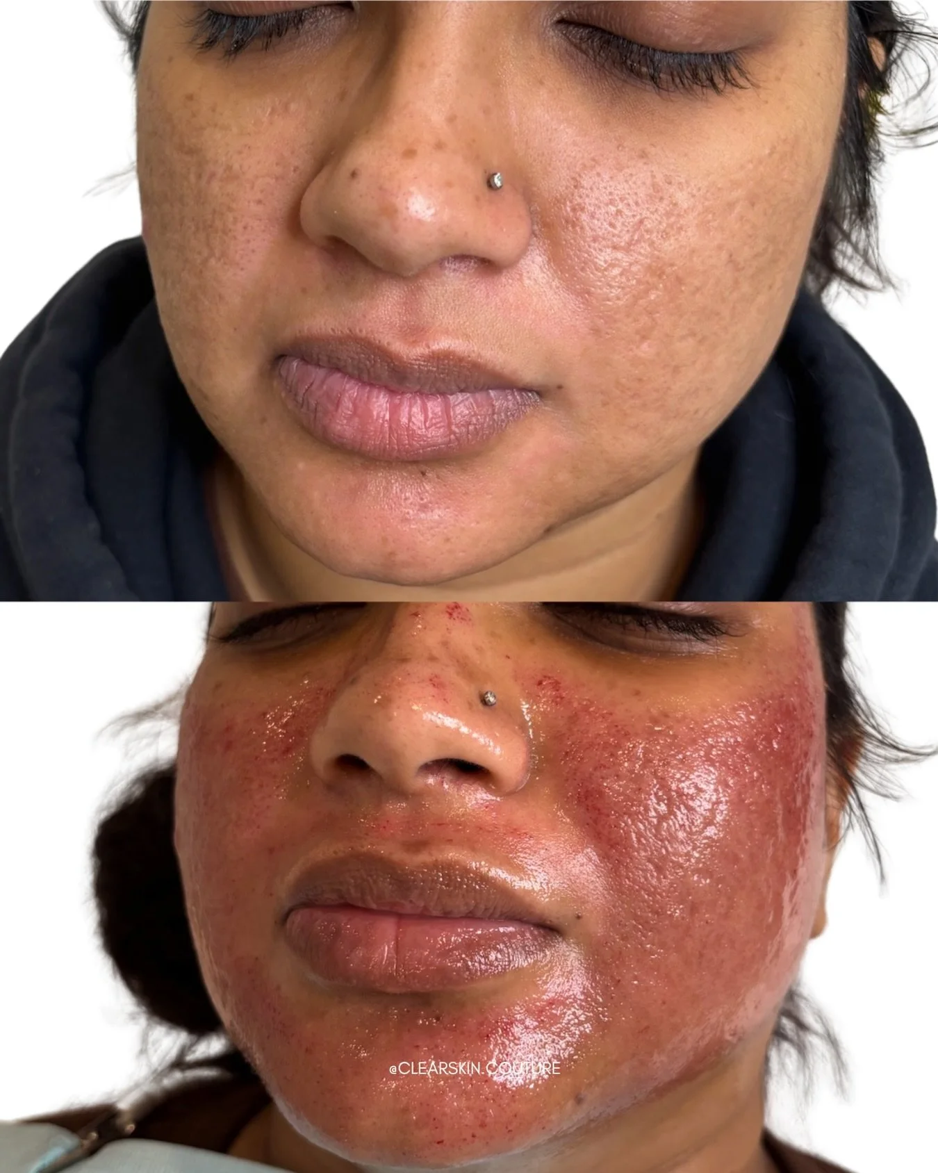 Microneedling immediately after treatment ✨

For patients looking to improve acne scars, the treatment depth is adjusted to reach the layers of skin where collagen remodeling happens. Because of this deeper setting with the Candela microneedling devi