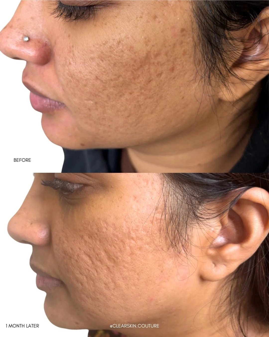 One month later&hellip;

This is where the transformation begins. 

Acne scars and pigmentation don&rsquo;t disappear overnight, but at 4 weeks, you can start to see real change as collagen production increases and skin turnover improves.

What we&rs