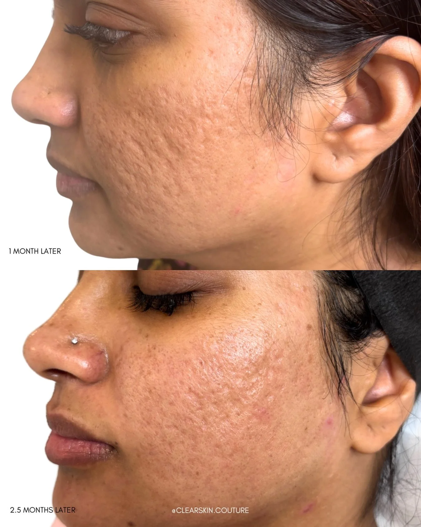 Acne scar correction takes time, consistency, and the right treatment plan ✨

These progress photos show the difference between 1 month vs 2.5 months after a physician customized combination of microneedling and chemical peels designed to improve acn