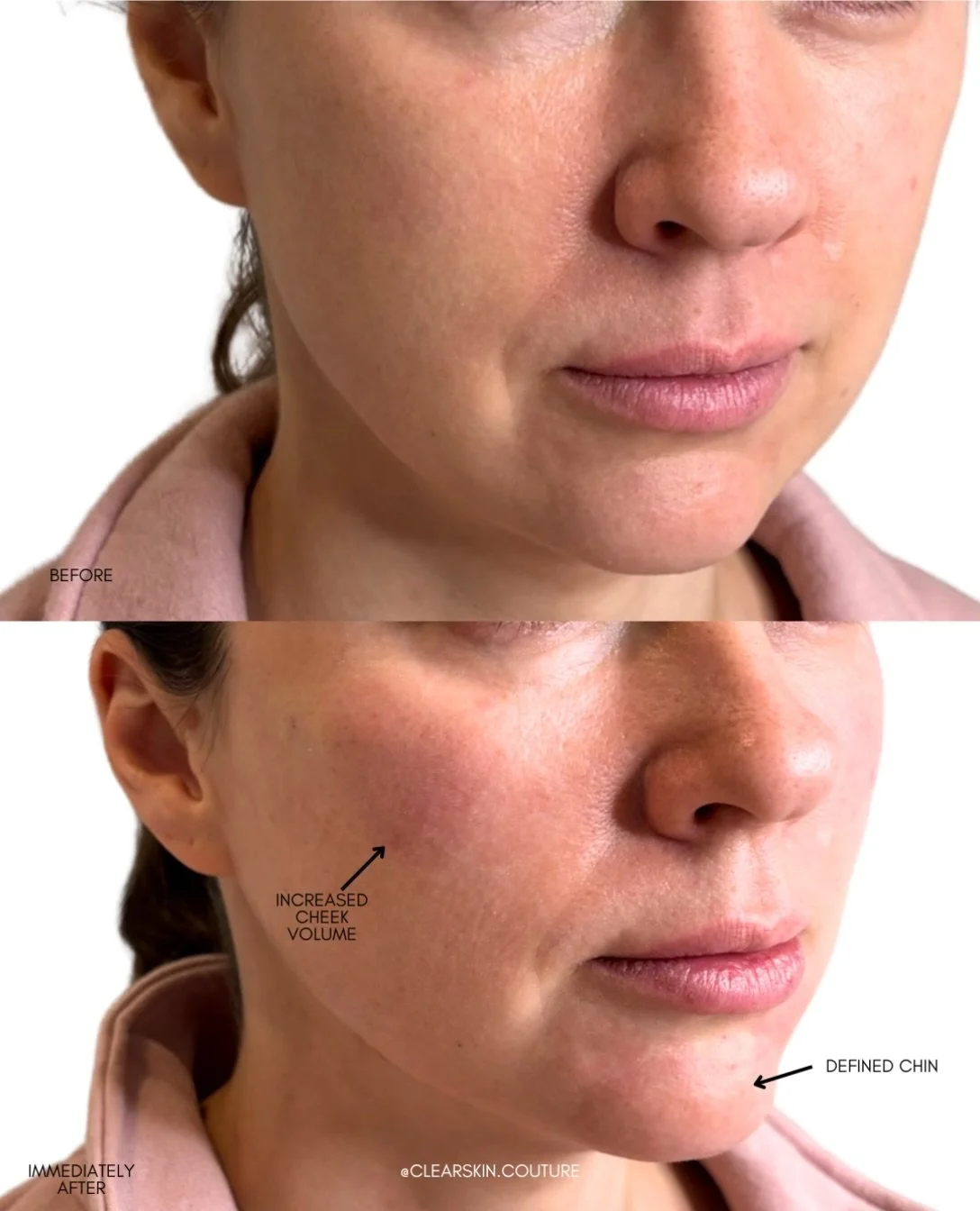 Radiesse to the upper face and chin, with the goal of a natural look. Subtle, balanced, and still very much you.

Dr. Alina Nazar takes the time to understand what you want and what makes sense for your face, so the result looks like a refreshed vers