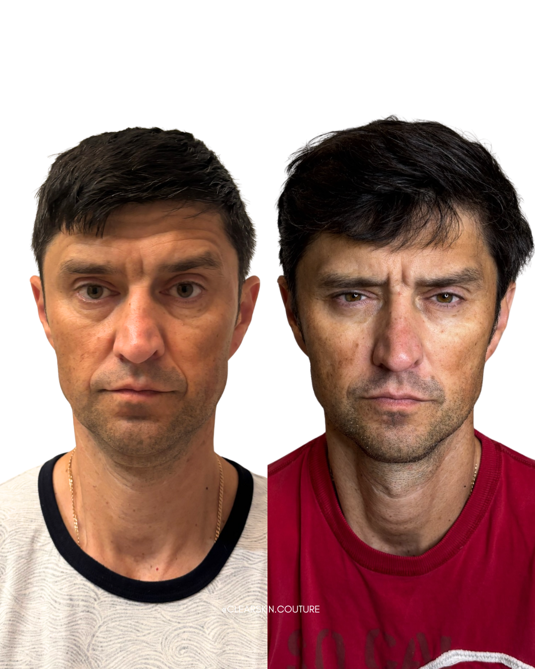 Full-Face Sculptra Results After One Year

This treatment provides comprehensive facial rejuvenation, restoring volume and enhancing natural contours while maintaining a masculine appearance. Over the course of a year, Sculptra stimulates collagen pr
