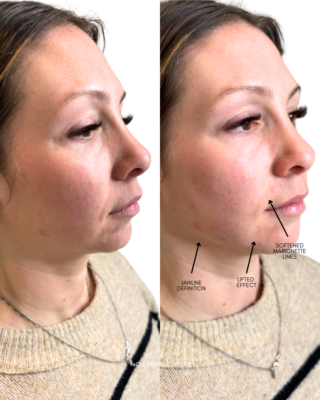 Before and After: Lower Face Rejuvenation with Radiesse

This transformation focused on executing the client’s goal of restoring structure, enhancing jawline contour, and achieving a naturally lifted lower face without looking overfilled. 

Using Rad