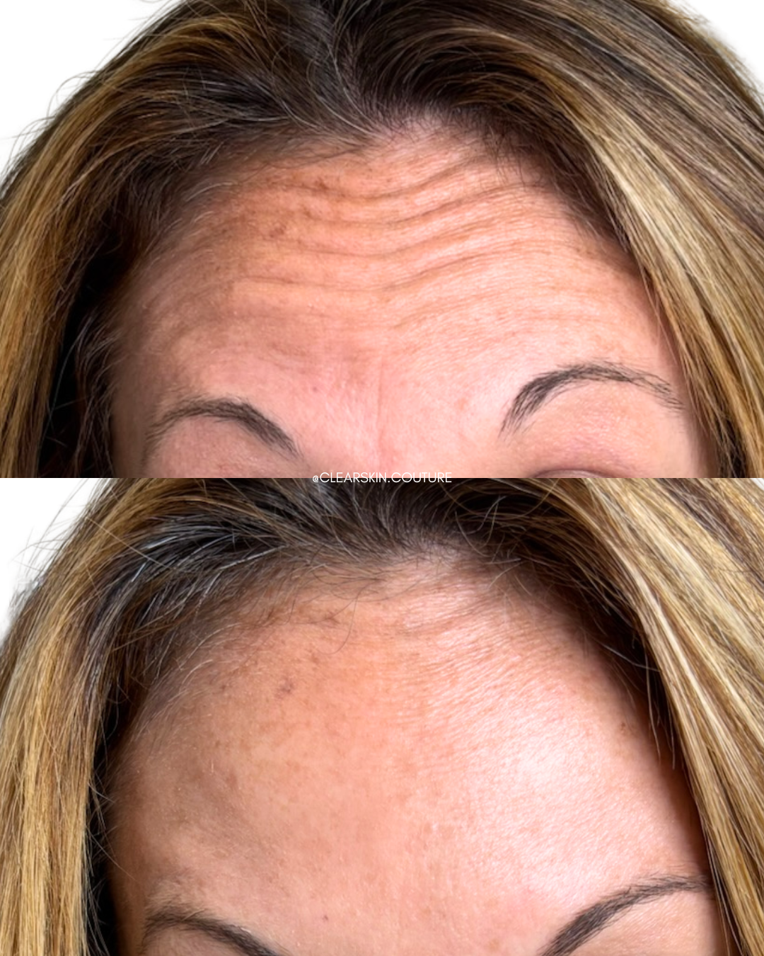 Forehead Lines and Frown Lines (11s) with Dysport

This treatment softens forehead lines and the “11” frown lines between the brows for a smoother, more relaxed appearance. Dysport targets the underlying muscles to reduce wrinkles while preserving na