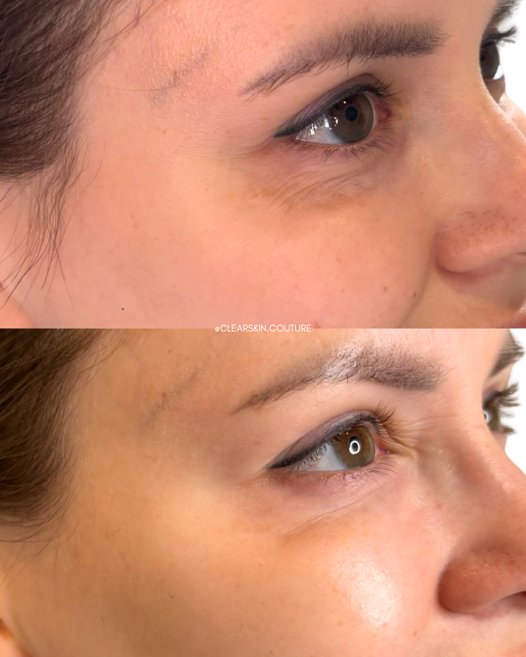 Crows Feet Treatment with Dysport

This treatment smooths the appearance of crows feet for a more youthful, refreshed look. Dysport relaxes the targeted muscles, reducing fine lines while maintaining natural facial expressions. Results appear gradual