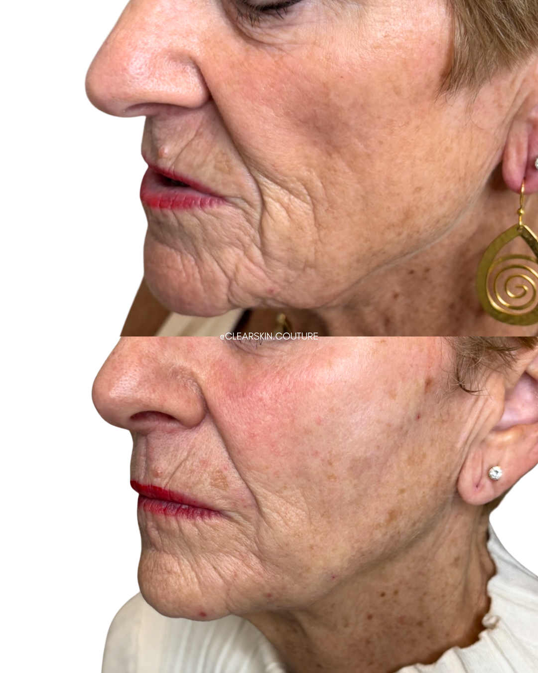 Sculptra Results After a Few Months

This treatment gradually restores volume and improves facial contour for a natural, lifted appearance. Sculptra stimulates collagen production, so results continue to develop over several months. After just a few 