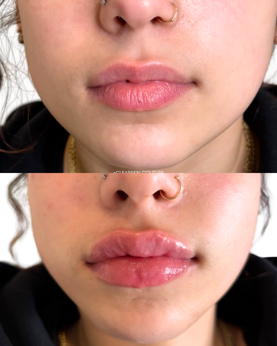 Lip Filler Results

This treatment enhances the lips for a naturally full look with immediate results. Using precise placement, volume and shape are balanced for a soft, flattering appearance. Clients leave with visibly plump lips that maintain a nat