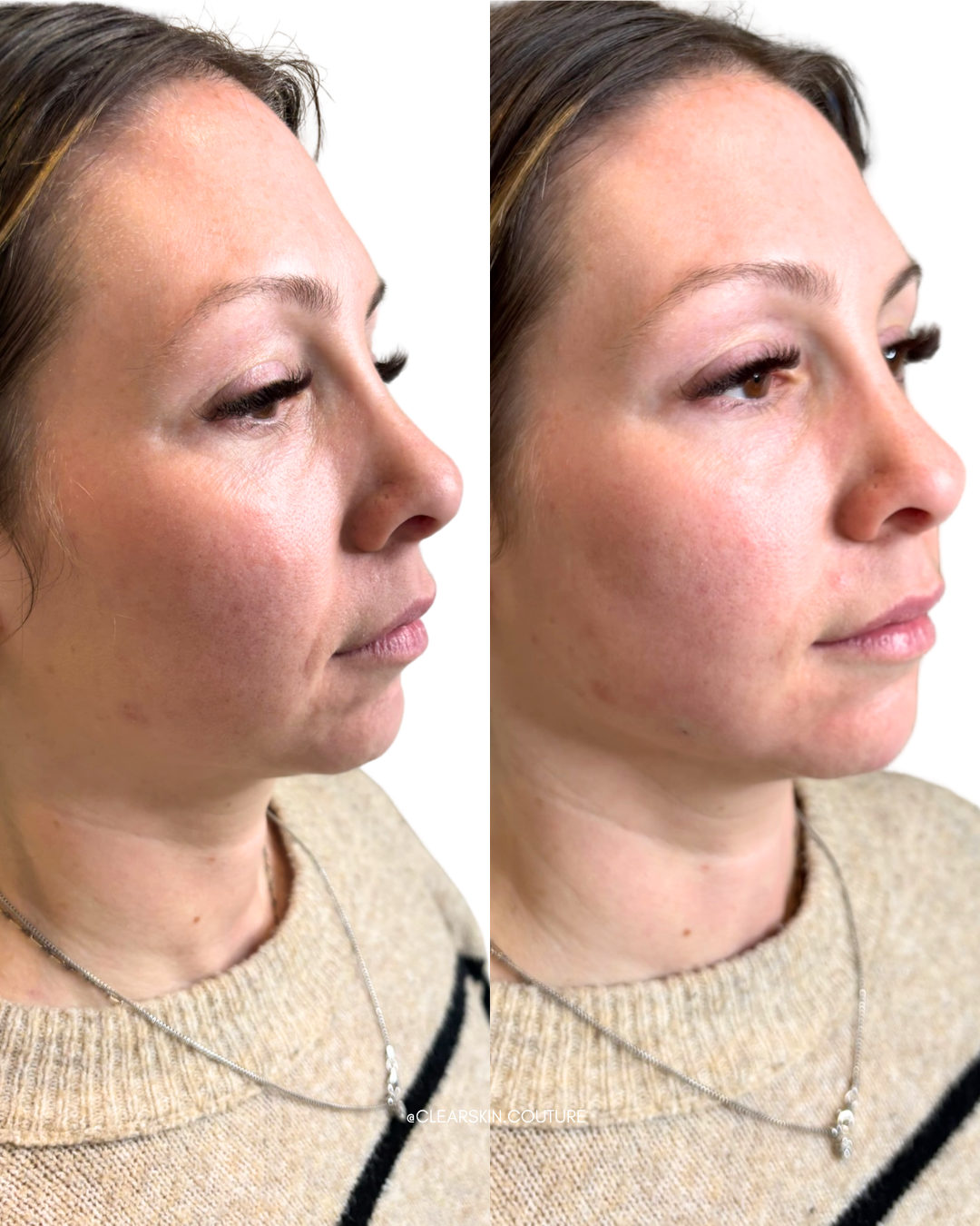 Before and After: Lower Face Rejuvenation with Radiesse

This transformation focused on executing the client’s goal of restoring structure, enhancing jawline contour, and achieving a naturally lifted lower face without looking overfilled. 

Using Rad