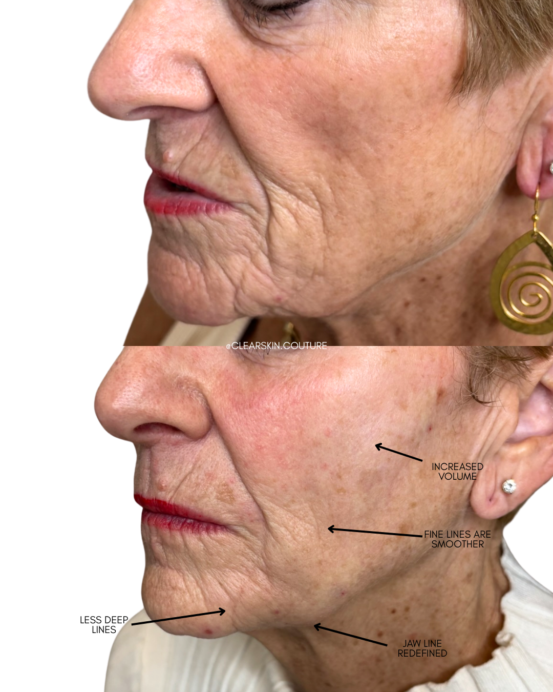 Sculptra Results After a Few Months

This treatment gradually restores volume and improves facial contour for a natural, lifted appearance. Sculptra stimulates collagen production, so results continue to develop over several months. After just a few 