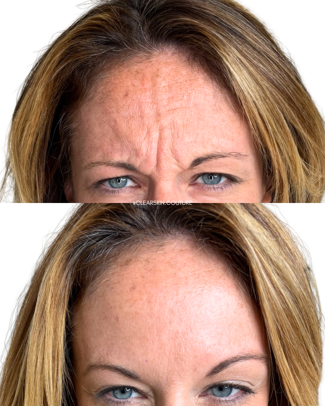 Forehead Lines and Frown Lines (11s) with Dysport

This treatment softens forehead lines and the “11” frown lines between the brows for a smoother, more relaxed appearance. Dysport targets the underlying muscles to reduce wrinkles while preserving na