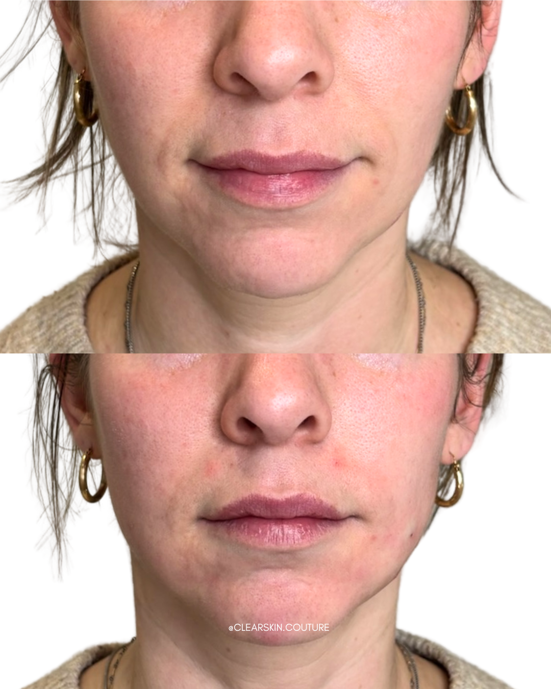 Before and After: Lower Face Rejuvenation with Radiesse

This transformation focused on executing the client’s goal of restoring structure, enhancing jawline contour, and achieving a naturally lifted lower face without looking overfilled. 

Using Rad