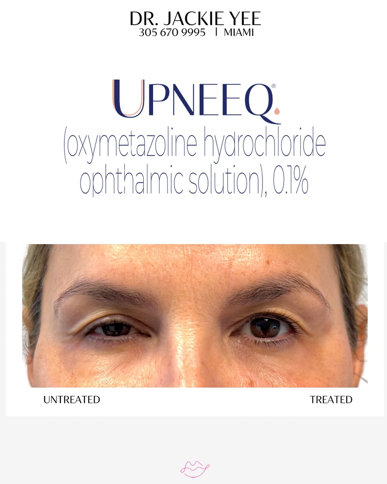 Take a look at the power of UPNEEQ&mdash;this is just 15 minutes after applying the drop to one eye.

You can see the clear difference: one eye looks more open, lifted, and refreshed, while the untreated side still appears tired and heavy. That&rsquo