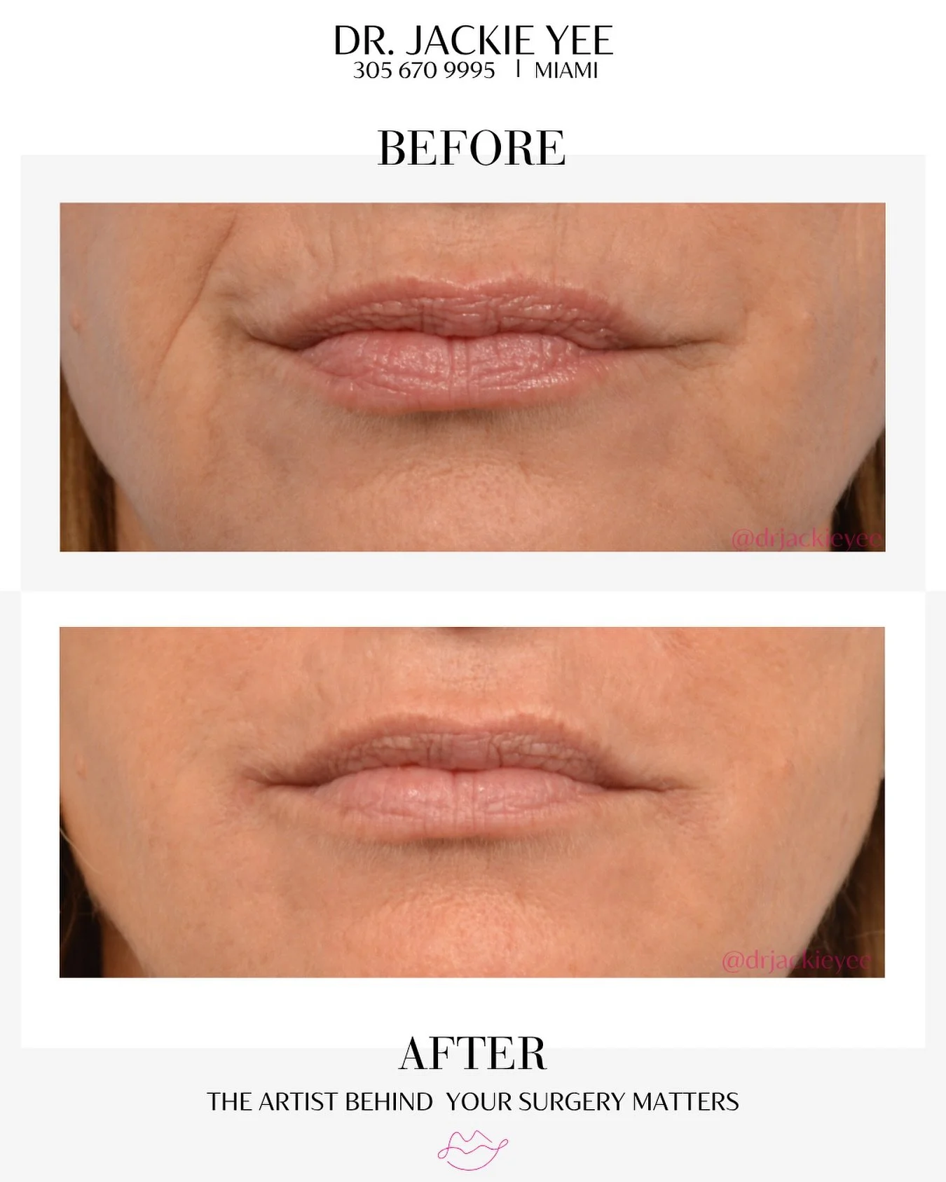 When filler is done well, it doesn’t change your appearance, it simply refreshes and softens what’s already there.
In this case, Dr. Yee treated fine lines in the perioral area (around the mouth) using carefully placed dermal filler, no