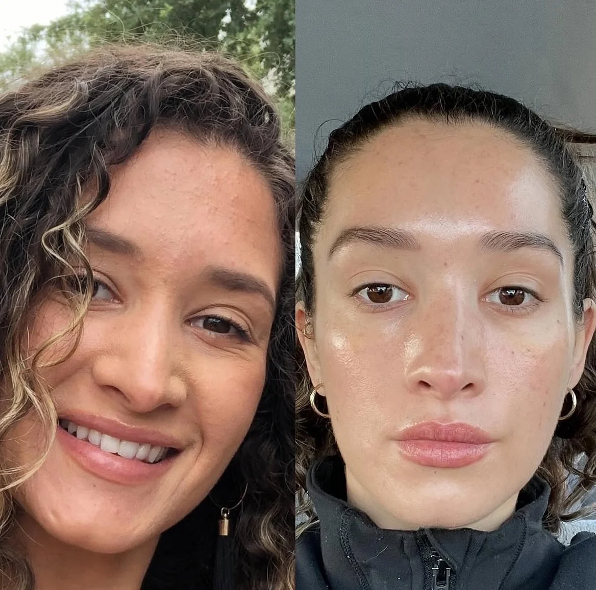 β¨ Real Results from Real Consistency β¨
Swipe to see our amazing PA, Nelly’s skin transformation! 
She committed to a consistent treatment and skincare routine, and the results speak for themselves. Here’s what she did:
β
 6 SkinPen micr