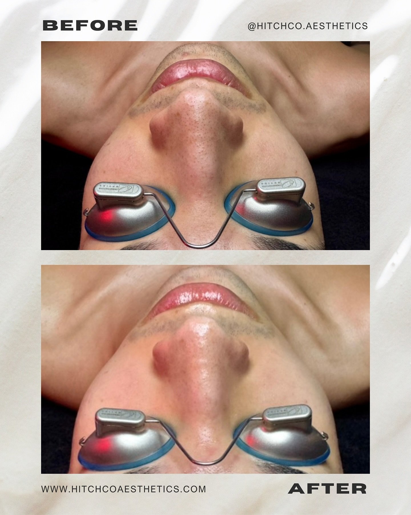 Hydration was the assignment &mdash; and we understood it. 💧 This Essential facial featured a customized double mask, barrier-focused hydration, and gentle extractions to refine without compromising the skin. Calm, clear, and visibly refreshed &mdas