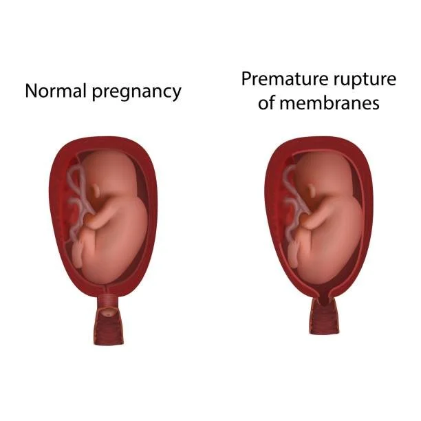 Uterine Rupture: A Life-Threatening OB Emergency with Legal Consequences