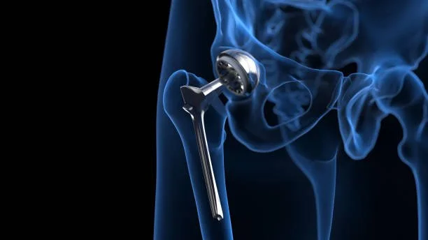 Hip Implant Failure 3 Years After Surgery—Is It Too Late to Sue?