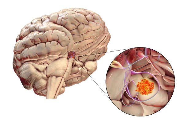 Failure to Diagnose a Brain Tumor Until It’s Too Late: How Attorneys Can Prove Harm