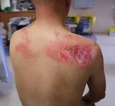 Surgical Burns and Positioning Injuries: Who’s Responsible?