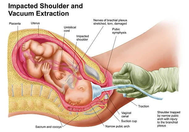 When Shoulder Dystocia Leads to Brachial Plexus Injuries—Legal Insights