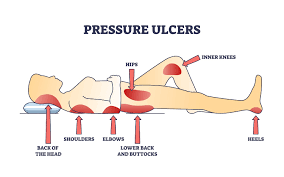 Bedsores (Pressure Ulcers): Preventable or Negligent?