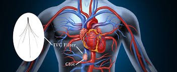 IVC Filter Complications: What Plaintiffs Must Prove