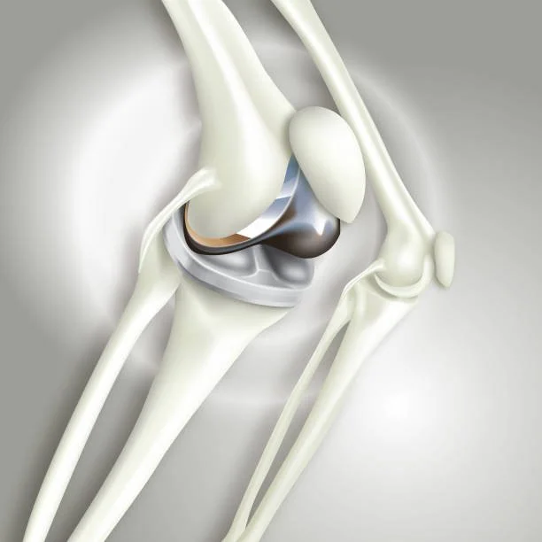 Hip &amp; Knee Implant Recalls—How Attorneys Use Medical Chronologies