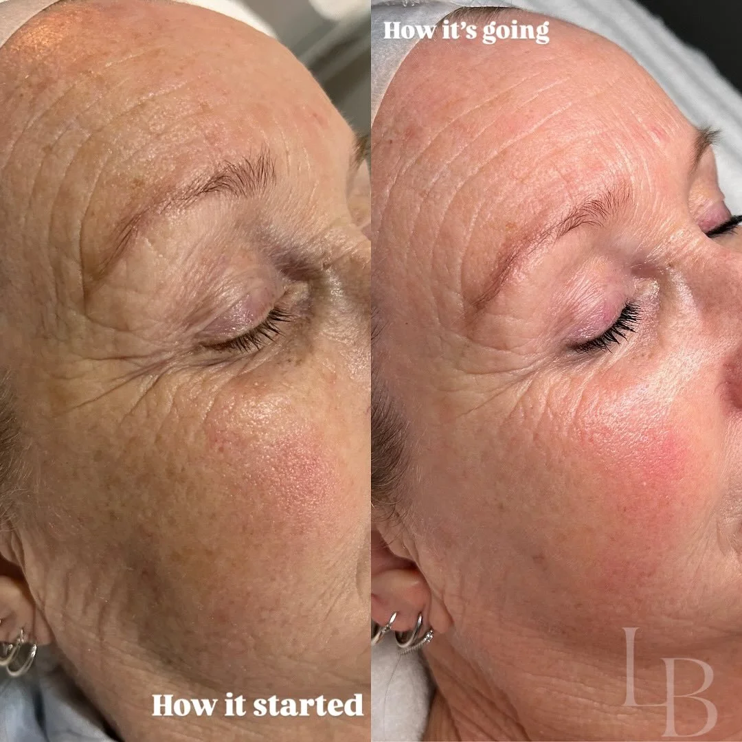These results are the outcome of a personalised skin plan, consistency at home, professional treatments and understanding what your skin truly needs &mdash; not just following trends 
At La Beaute we focus on long term skin health &amp; we would love