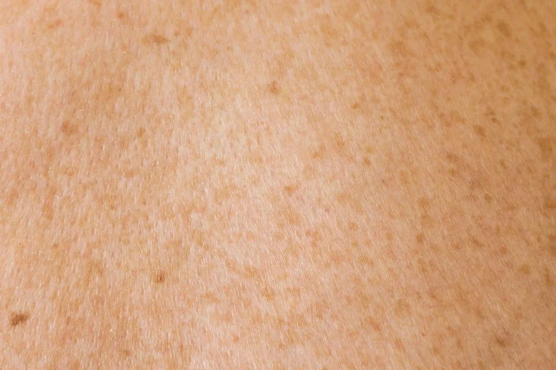 Piel y Ayurveda: psoriasis, eczema y desequilibrio Pitta