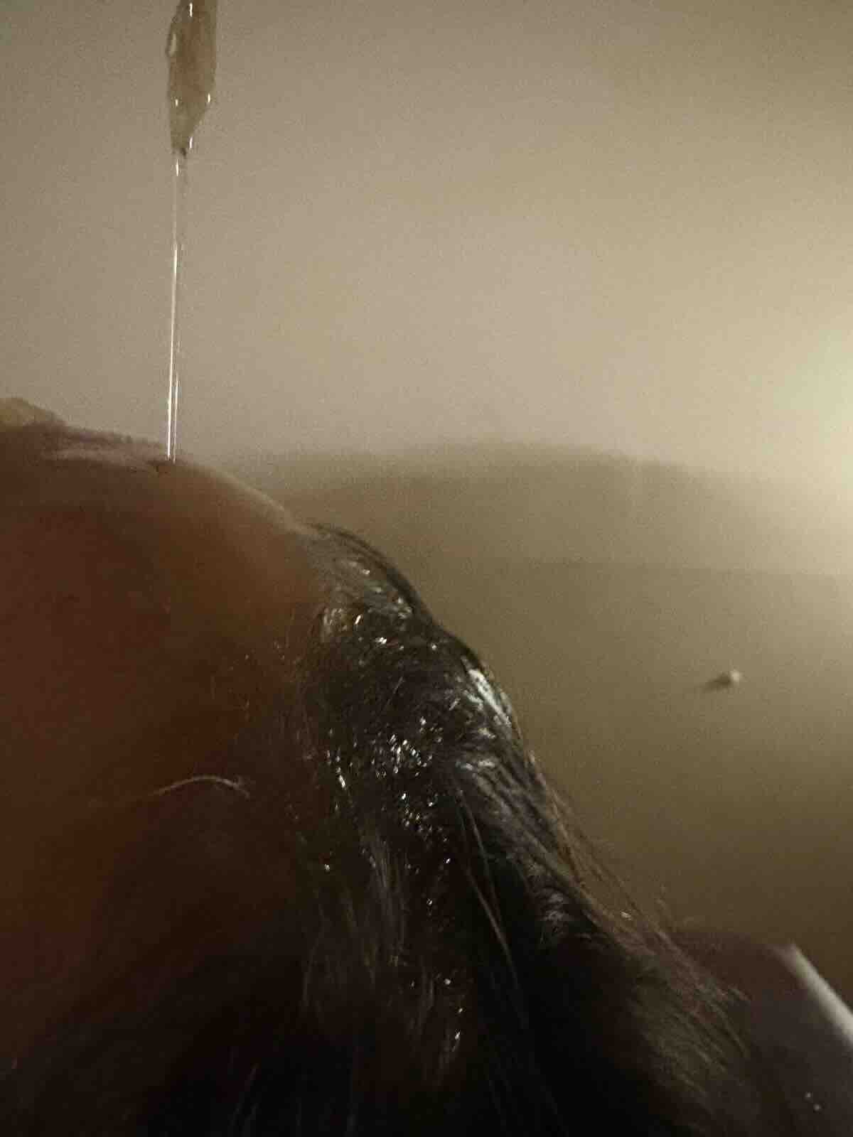 Ayurvedic Sirodhara therapy, in which warm oil is poured over the forehead to relax the nervous system