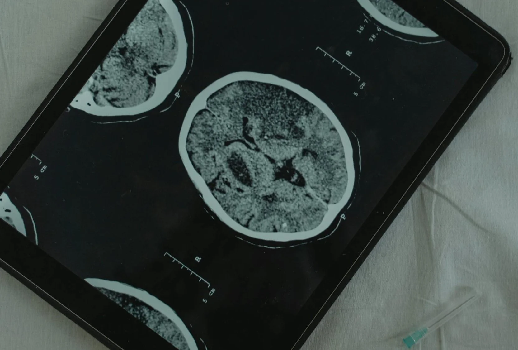 How the Brain Signals and Interprets Pain: The Science Behind What You Feel