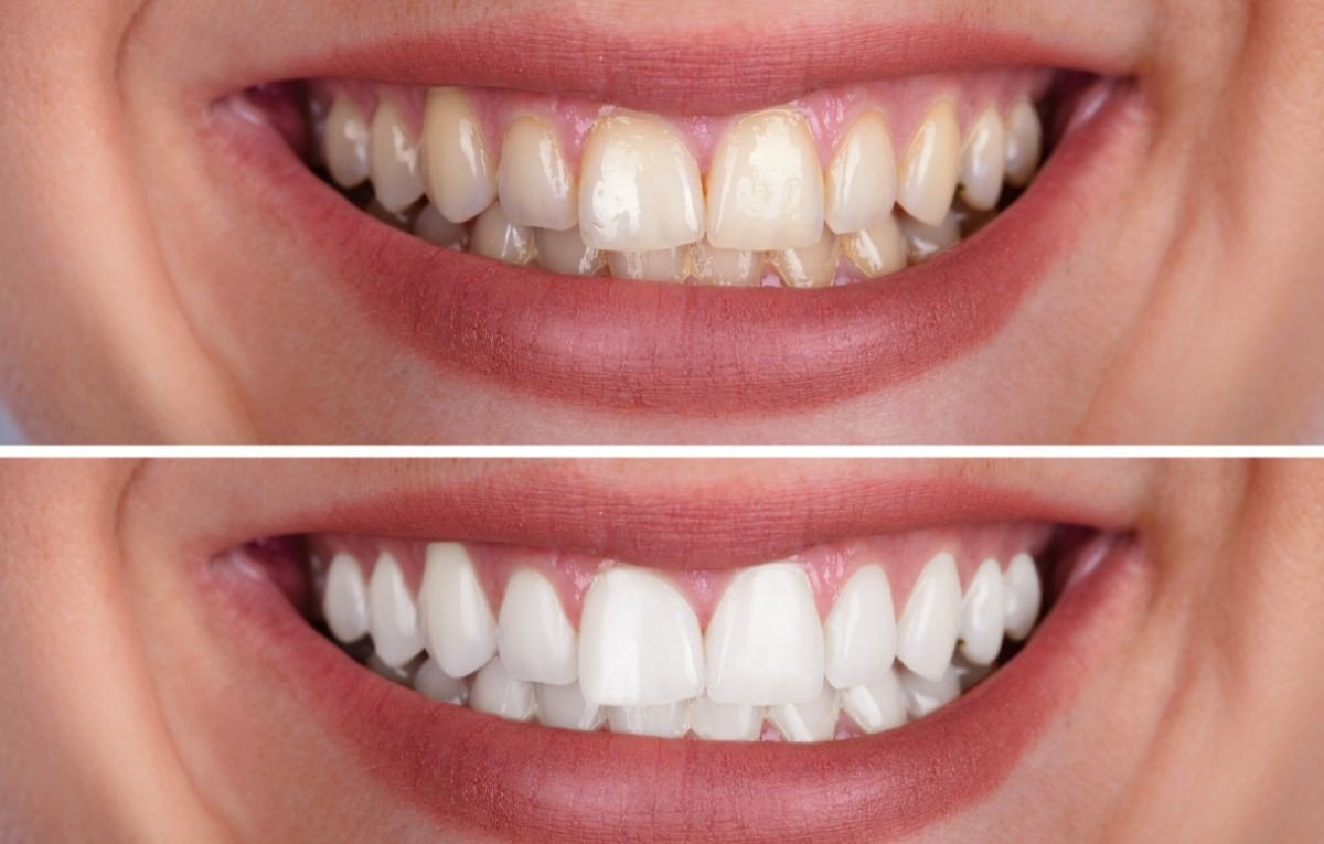 Quer um sorriso brilhante? Descubra o segredo do clareamento dental!