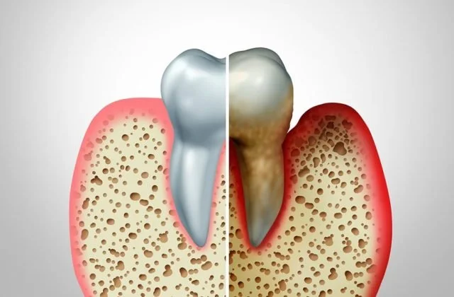 Doença Periodontal: A inflamação silenciosa que pode comprometer sua saúde. 