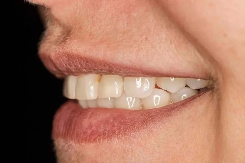Dentes desgastados e dores na face? Entenda o bruxismo