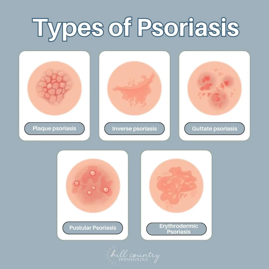 ✨ Did you know there’s more than just one type of psoriasis? ✨
From the most common plaque psoriasis to rarer forms like erythrodermic psoriasis, each type looks and feels different. Here are 5 types that we see often (although there are more s
