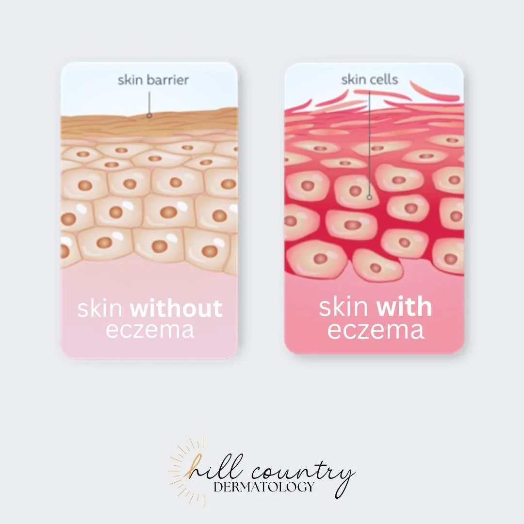 Eczema isn’t just dry skin - it’s actually a weakened skin barrier caused by genetics and influenced by environment.
This is why you hear us say "Moisturize, moisturize, moisturize!" because eczema flares are due to the rapid mo