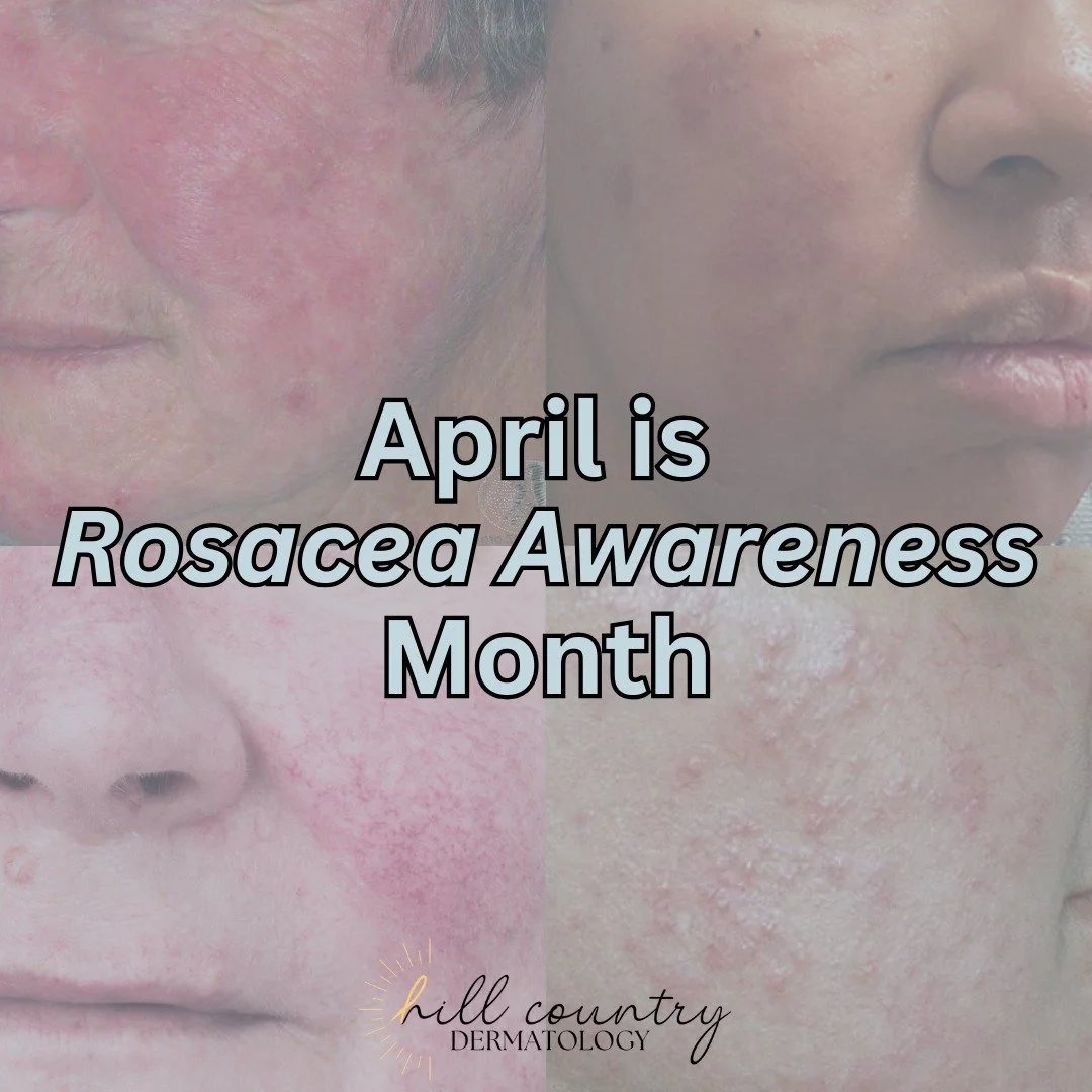 April is Rosacea Awareness Month! ❤️🩷

Rosacea isn&rsquo;t just &ldquo;sensitive&rdquo; or "red" skin. It&rsquo;s a CHRONIC &amp; frustrating condition that causes redness, flushing, visible and even sometimes broken blood vessels, and bre