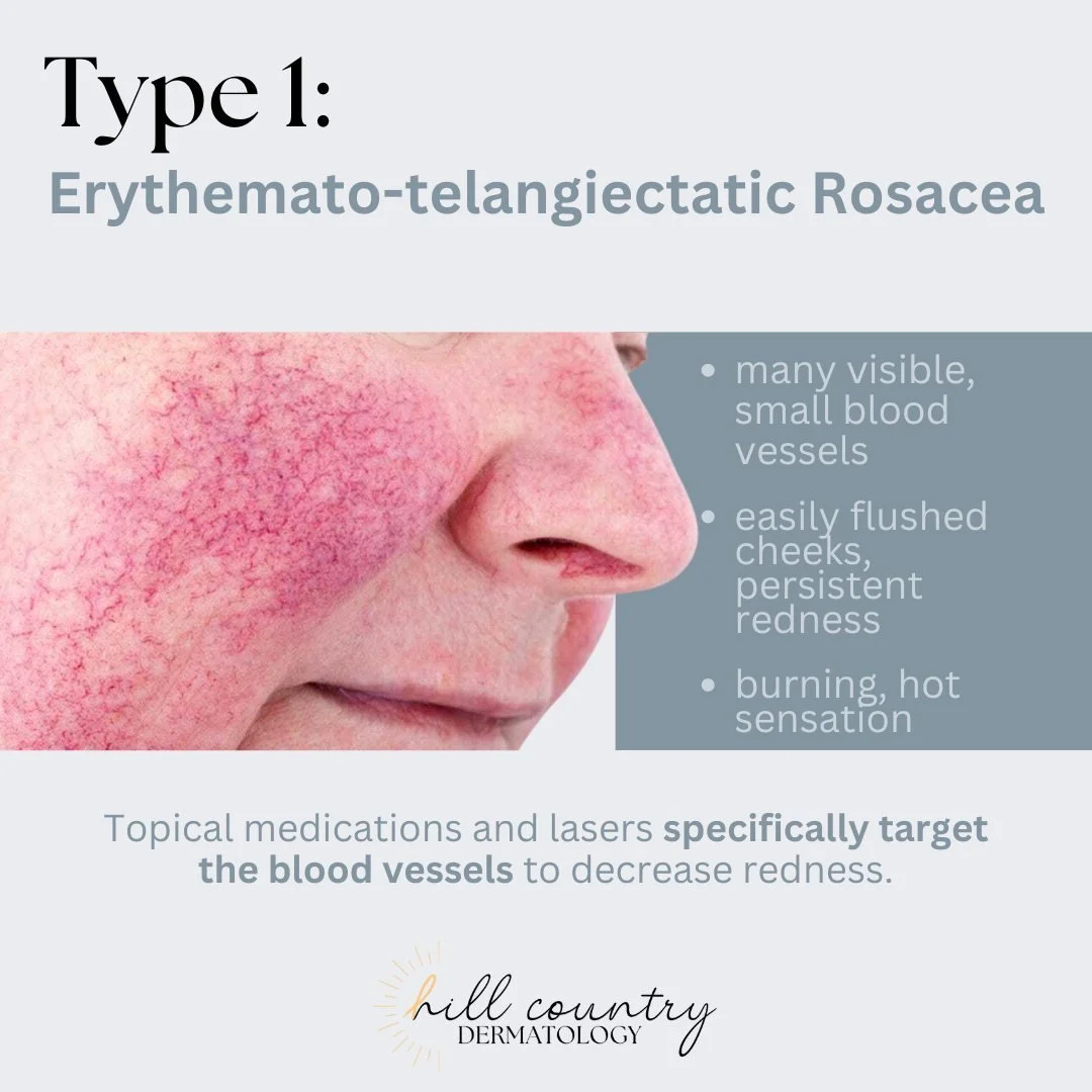 Let&rsquo;s break down the 4 main types of rosacea! Not all &ldquo;redness&rdquo; is the same, and treatment really depends on what you&rsquo;re actually dealing with.❤

Type 1:
This one shows up as persistent redness with visible tiny blood vessels.