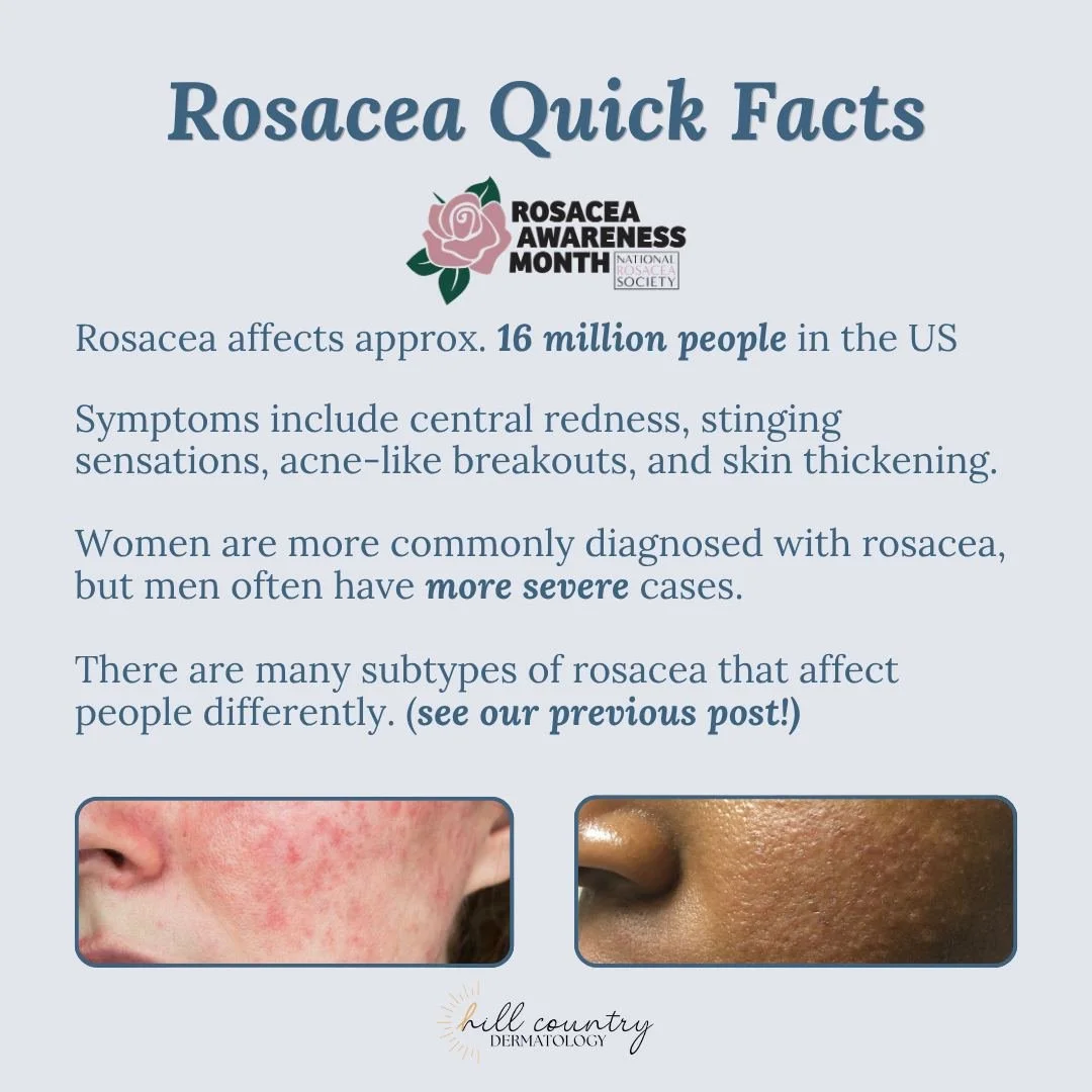 Rosacea is more than just redness - it&rsquo;s a chronic condition that can look different for everyone. Check out some quick facts about this condition!

#RosaceaAwareness #Dermatologistnearme #RosaceaCare #HillCountryDermatology #newbraunfelstx