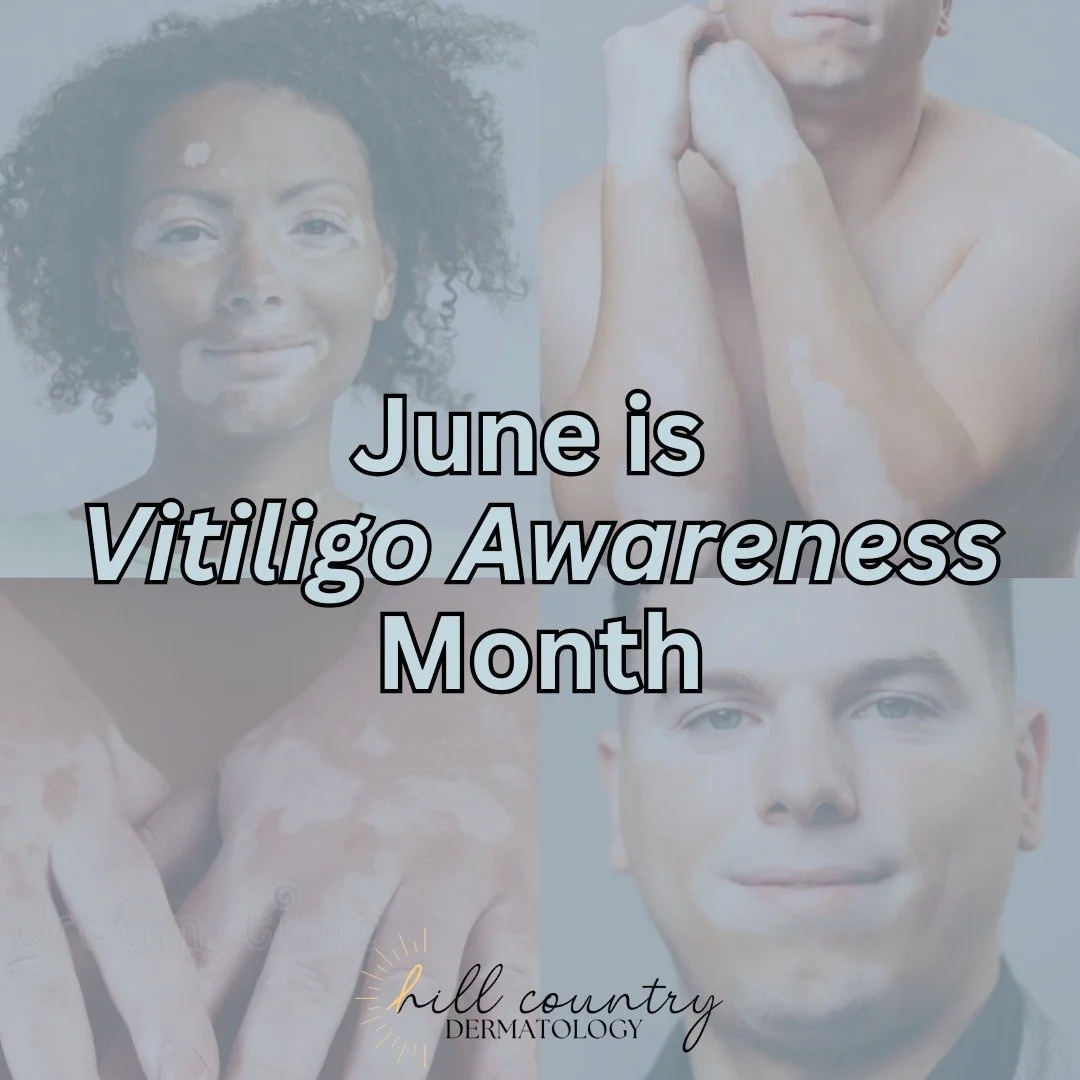 Have you ever heard of Vitiligo?

Vitiligo is a chronic autoimmune condition that causes the loss of pigment-producing cells in the skin, resulting in lighter patches of skin and hair. It can affect people of ALL ages, skin types, and ethnic backgrou