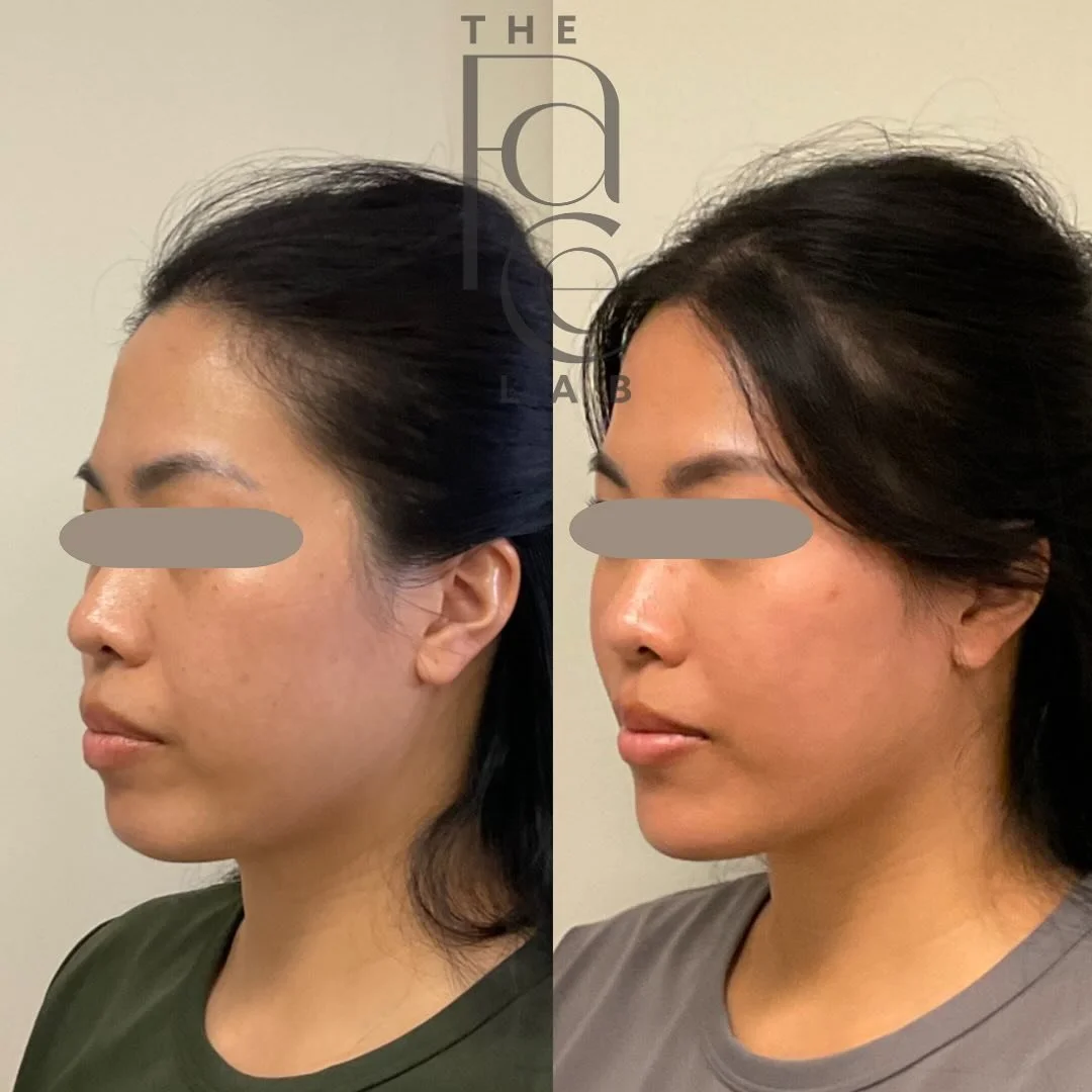 A gorgeous transformation that &ldquo;no one noticed&rdquo;, but the patient felt more confident, refreshed. 🤎

Can you tell what treatments were done to achieve this? 👀

We will share their treatment plan in the comments below. ⬇️

The Face Lab
📍