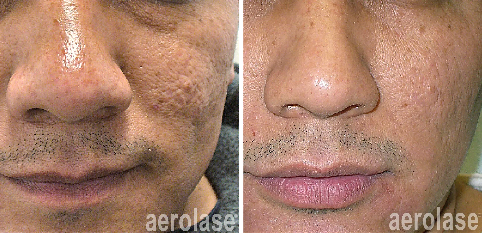 It’s official… The Face Lab is the FIRST clinic in Toronto to have the AeroLase
