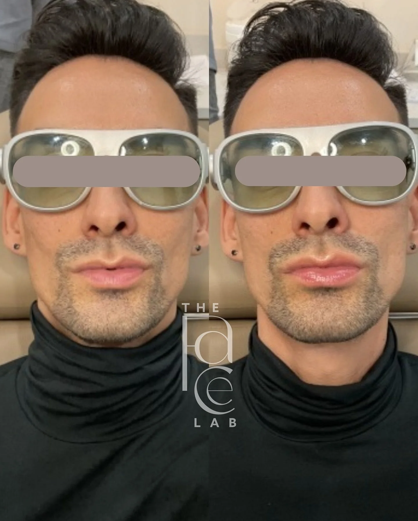 Get fuller, smoother lips without needles, downtime, or pain. 💋 
@aerolase Neo Lip Plump is a non-invasive laser treatment that enhances lip volume and color by stimulating your skin’s natural collagen production. ⚡️
 Aerolase’s 650-mi