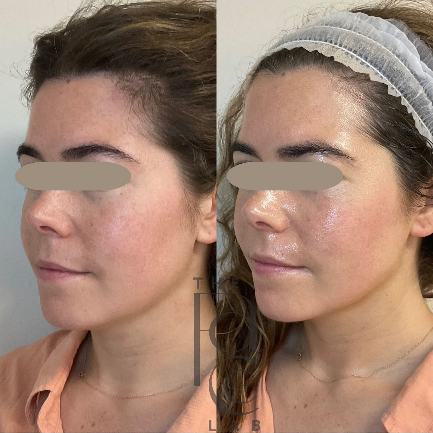 Deep hydration, lymphatic drainage, exfoliation, and reduced inflammation for an immediate glow from within. ✨

Our CryoGlow treatment uses @glacial.skin technology to target inflammation in the skin that leads to altered skin barrier, redness, and p