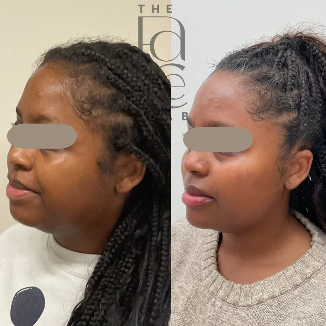 Every person has their own plan, because no 2 people are the same. 🫶🏽

A few different treatments were done in between these photos taken over a year apart.

Slide 1 &amp; 3 are immediate post-filler. 💉
Slide 2 &amp; 4 are following healed results