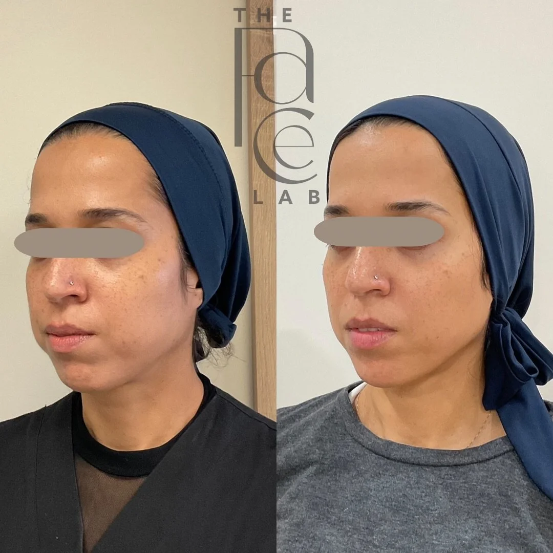Facial balancing with dermal filler is not about changing your face. It is about understanding it. We work with your natural anatomy to restore harmony, not overwrite what makes you, you. ✨

This treatment includes 3 syringes of dermal filler (just o