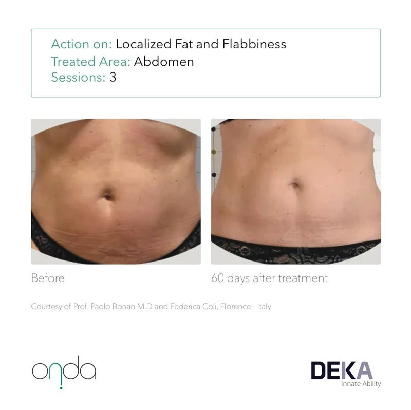 DEKA-ONDA-before-after-patient14-3tx-stomach.jpg