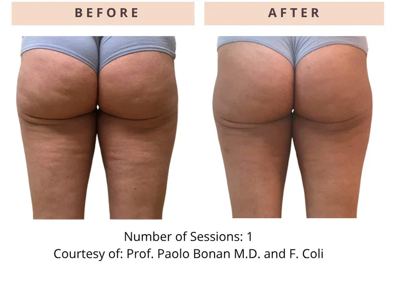 onda-pro-before-after-cellulite.webp